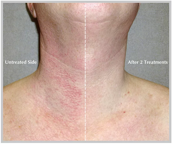 BBL Photorejuvenation Treatment Before and After