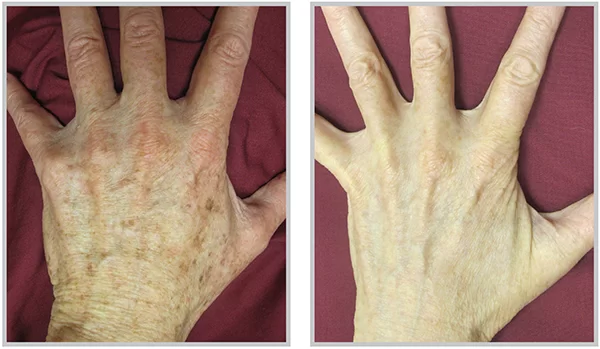 BBL Photorejuvenation Treated Hands Before and After