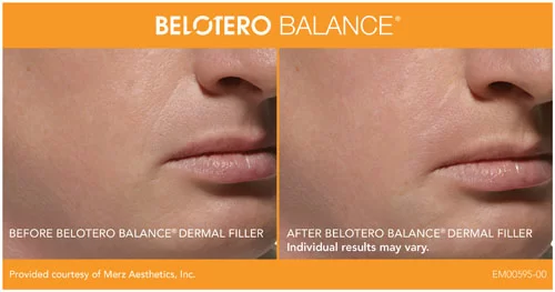 Belotero Balance Before and After