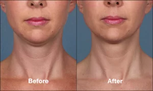 Kybella Treatment Before and After