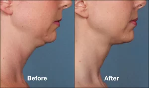 Kybella Treatment Before and After