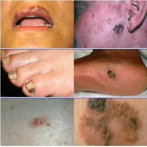 melanoma-examples