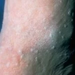 seborrheic-keratosis-2